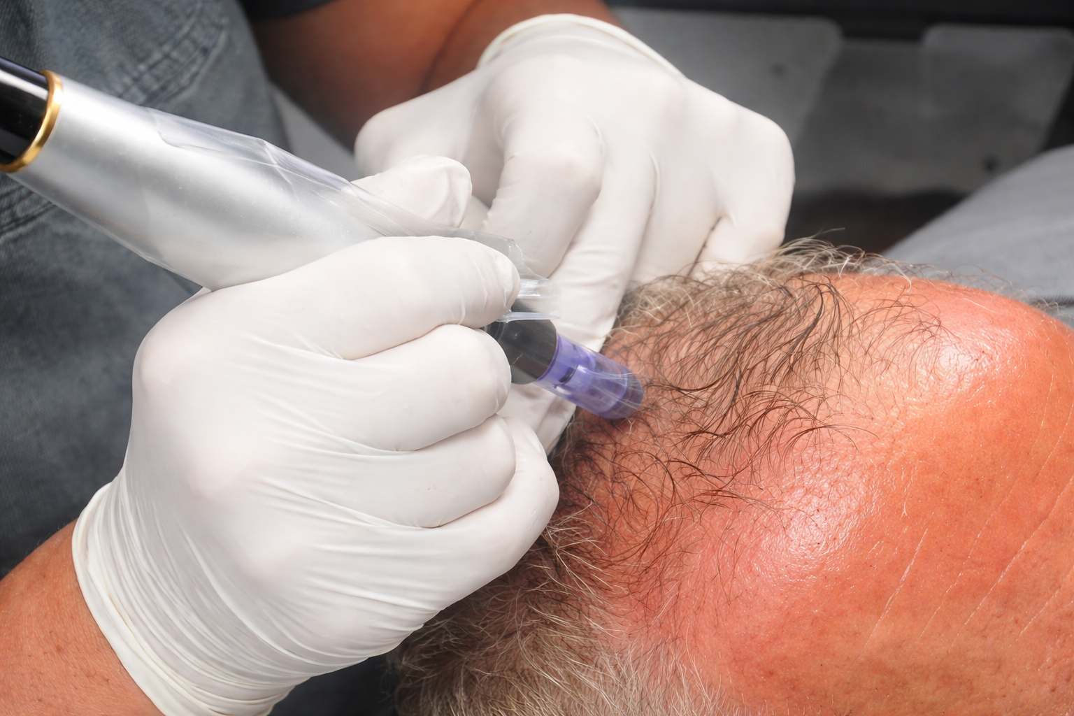 Hair and scalp rejuvenation microneedling treatment