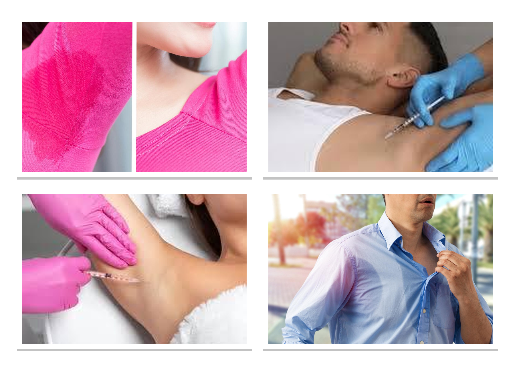 Hyperhidrosis treatment before and after clinical collage
