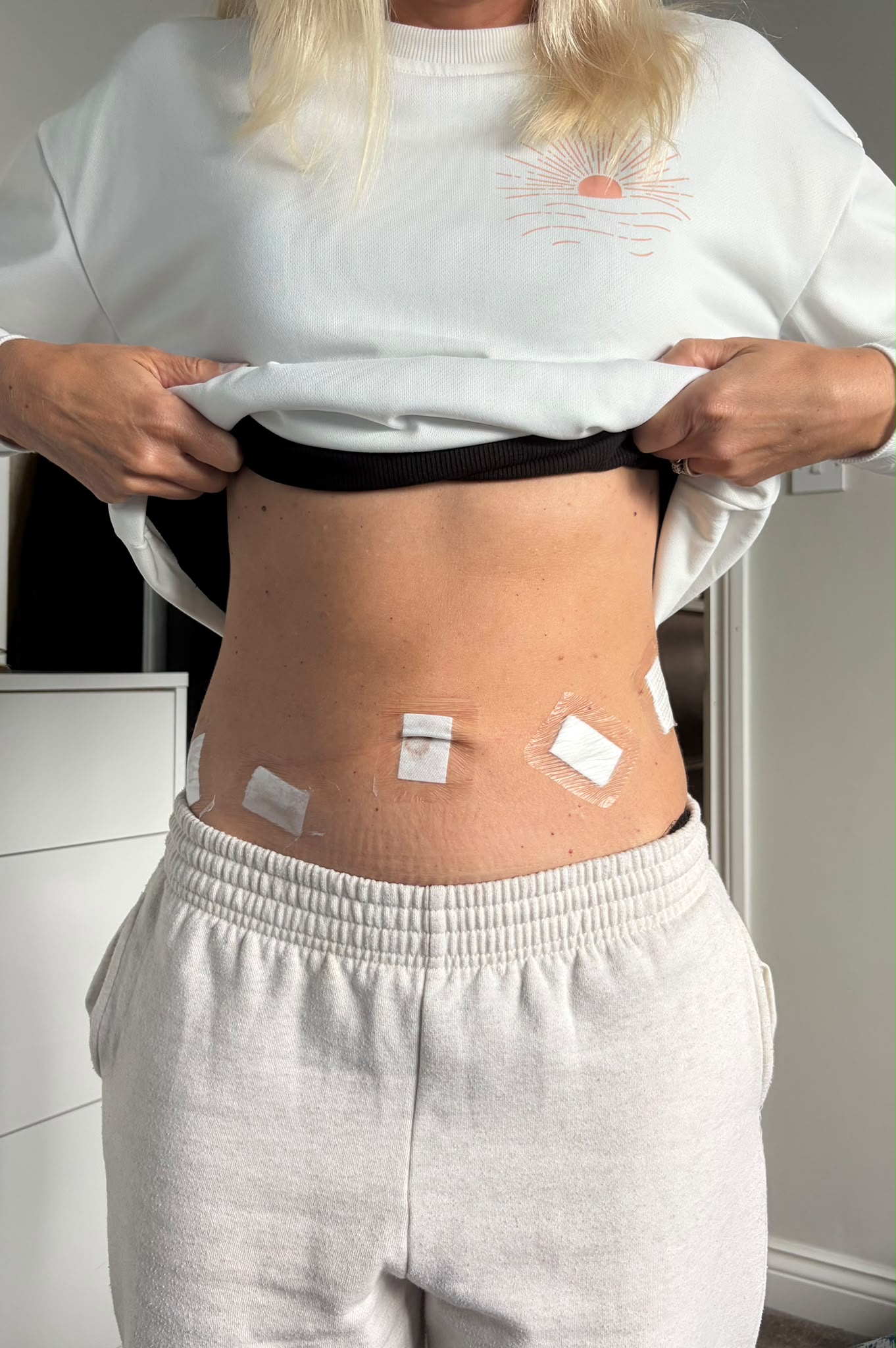Client-supplied photograph showing small dressings on the abdomen