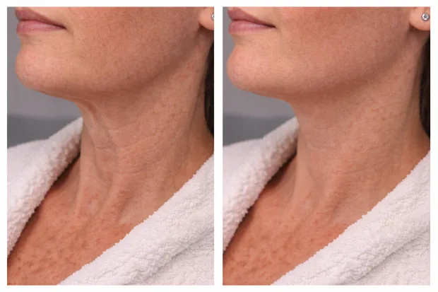 Platysma bands treatment before and after results