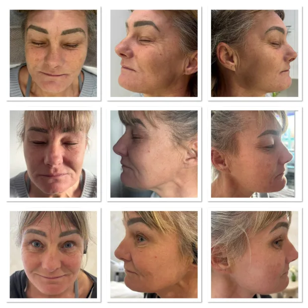 Micro SkinNeedling with Polynucleotides
