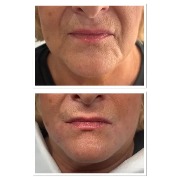 1.1ml Lumifill Dermal Filler