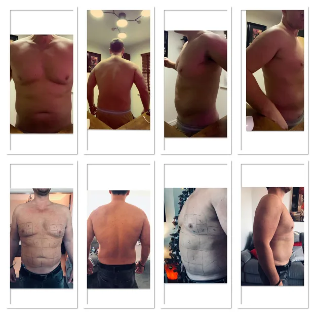 Before and after pics of lemon bottle fat dissolving men