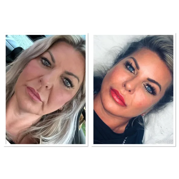 Dermal Filler Contour Package Lips, Cheeks, Nasolabial, Marionettes and Chin