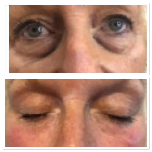 Tear Trough Dermal Filler