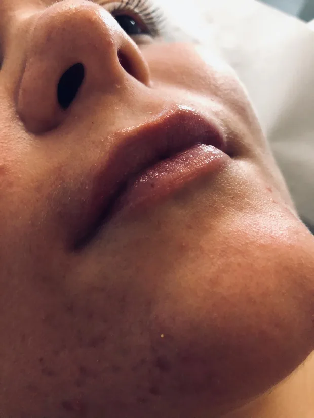 New Fresh Lips  0.5ml Dermal Lip Filler