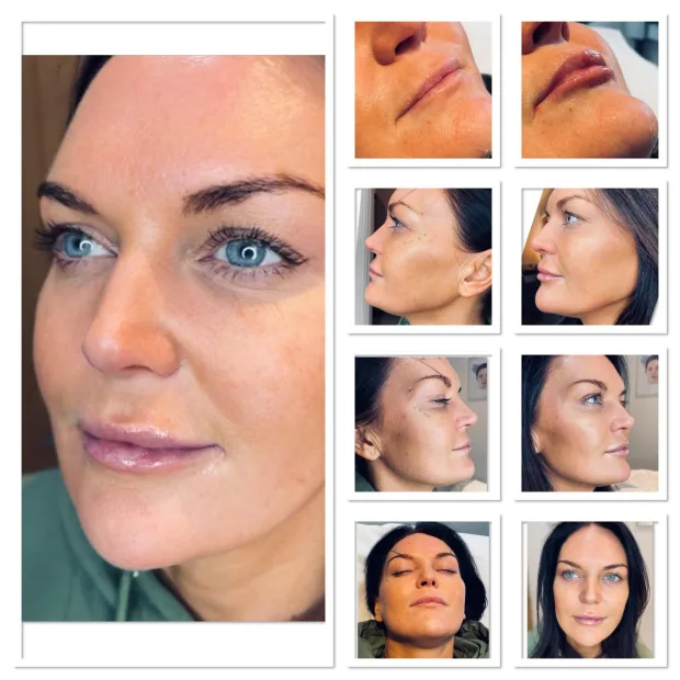 Before and after pics - Dermal Filler Lips, Chin and Jaw