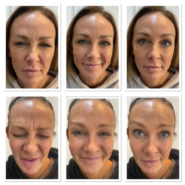 Anti wrinkle Treatment 3 Areas