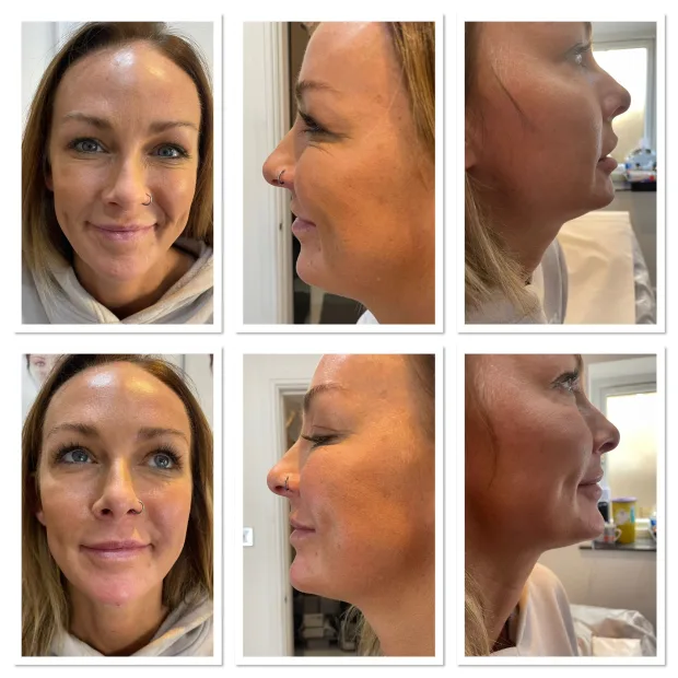 Dermal Filler Chin
