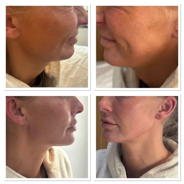 Dermal Filler - Jaw & Chin 5.5ml