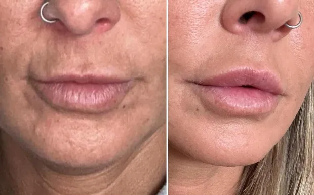 Antiwrinkle around the mouth and Lip Dermal Filler