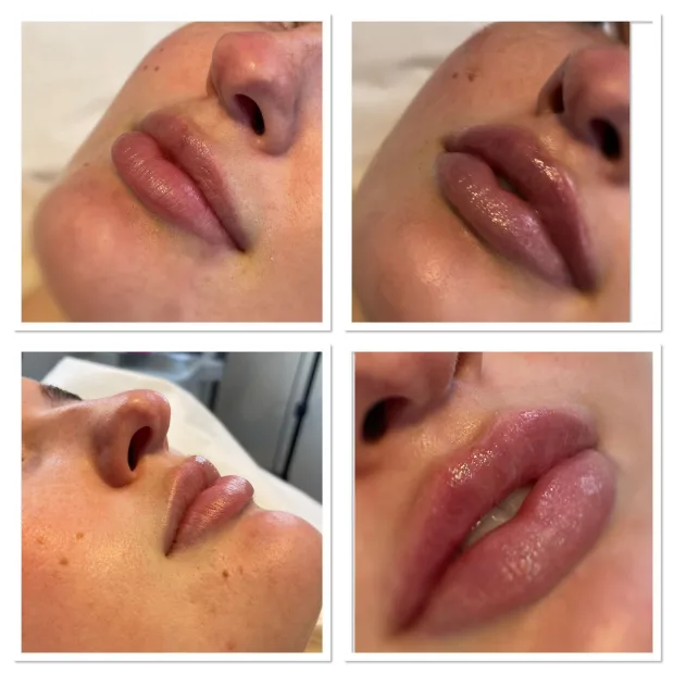 Dermal Lip Filler enhancing her own natural lips