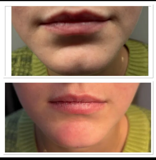 Chin Filler to remove the dimple