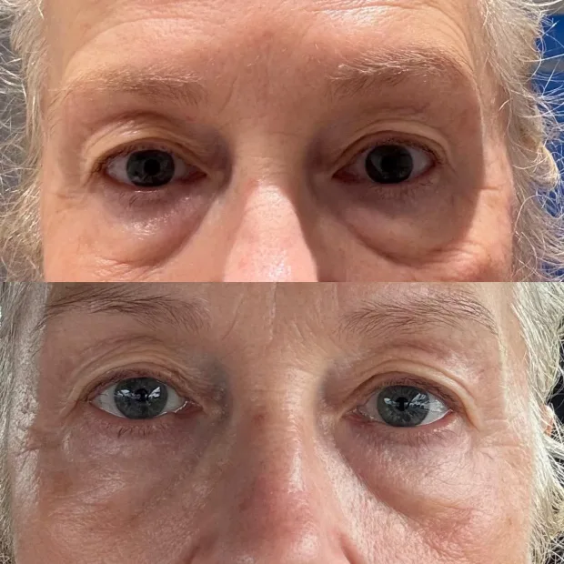 Under eye polynucleotides cannula technique